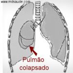 O QUE É PNEUMOTÓRAX?