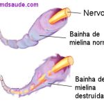 SÍNDROME DE GUILLAIN-BARRÉ | Sintomas e tratamento