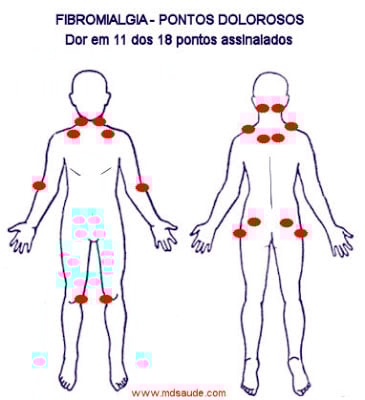 fibromialgia