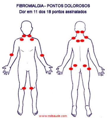 fibromialgia