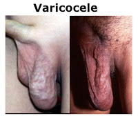 Varicocele - Haz clic para ampliar