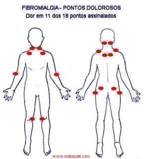 Fibromialgia