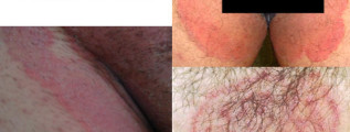 MICOSE NA VIRILHA – Tinea Cruris
