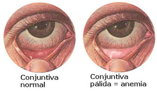 Conjuntiva pálida