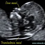 ULTRASSOM NA GRAVIDEZ