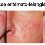 Que tal la psoriasis por que él surge