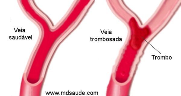 Resultado de imagem para Trombose