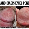 Que untar las juntas después de flebektomii