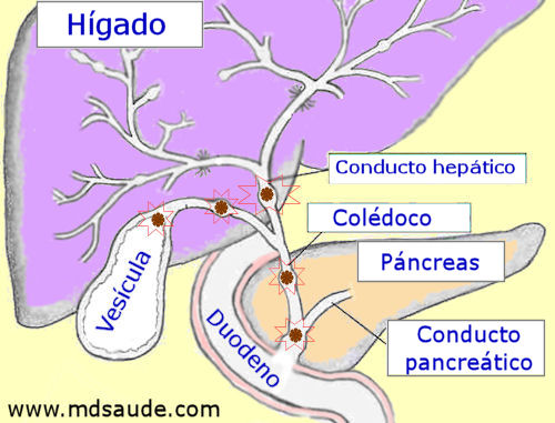 PIEDRA EN LA VESÍCULA | COLELITIASIS