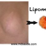 O QUE É O LIPOMA | Causas e Tratamento