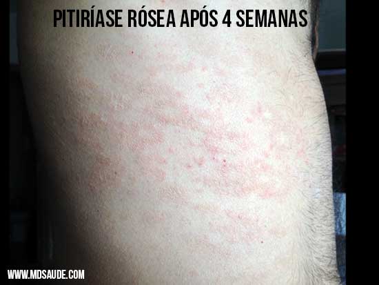 NICE Evidence Search | viral urticaria