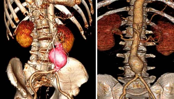 aneurisma-imagem Aneurisma
