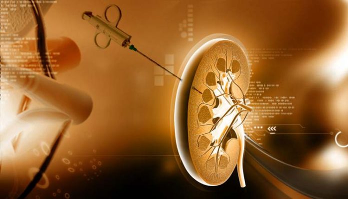 biopsia-renal-ilustracao Biópsia renal