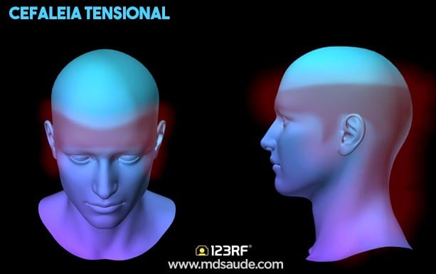 características da cefaleia tensional