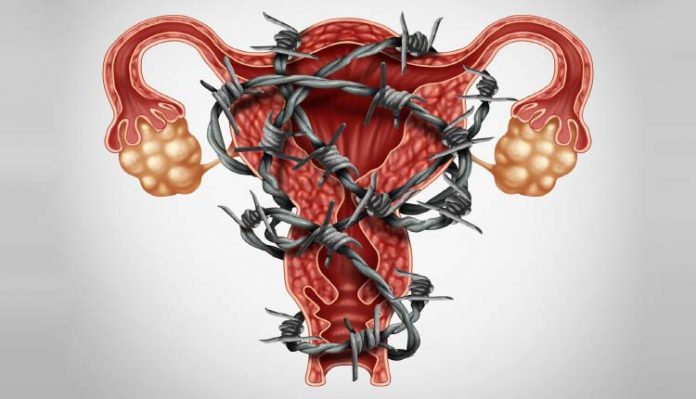 endometriose-ilustracao Endometriose