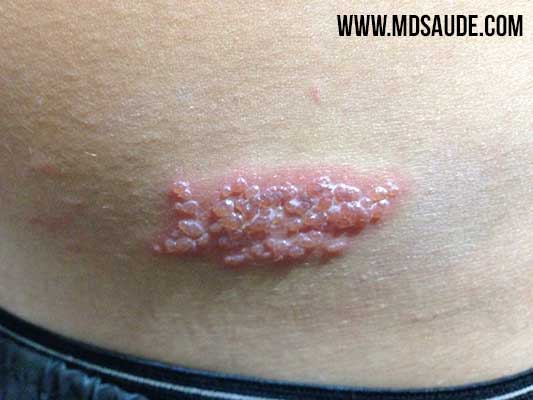 Genital herpes: MedlinePlus Medical Encyclopedia