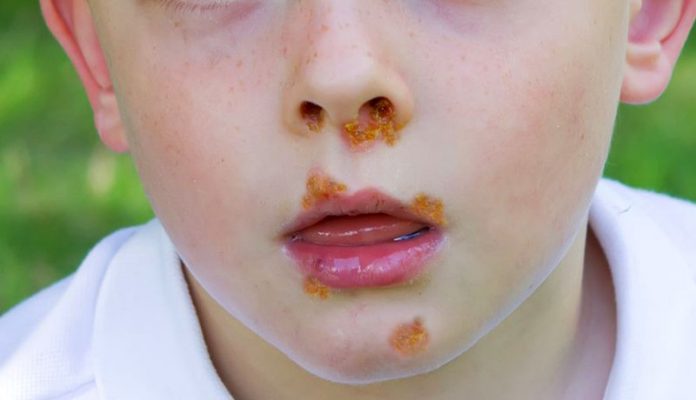 impetigo-imagem Impetigo na face