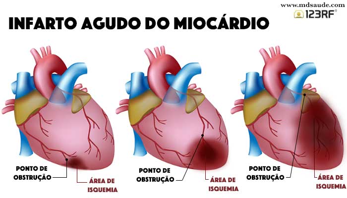 Enfarte agudo do miocárdio ou Ataque Cardíaco (coração)