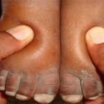 acido urico alto en hombres tratamiento naturista para bajar el acido urico alimentos para bajar el acido urico en la sangre