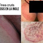 Sanar atopichesky la dermatitis al niño
