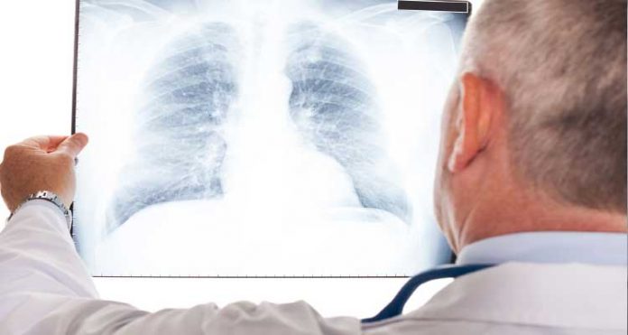 pneumonia-sintomas neumonía