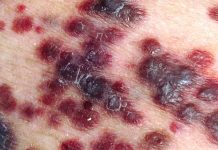sarcoma-kaposi-imagem-218x150.jpg