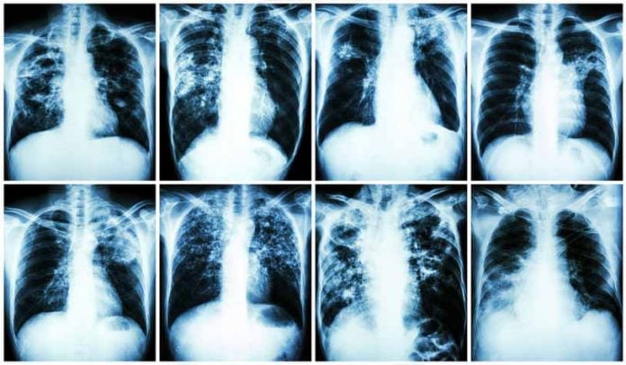 tuberculose-rx tuberculosis