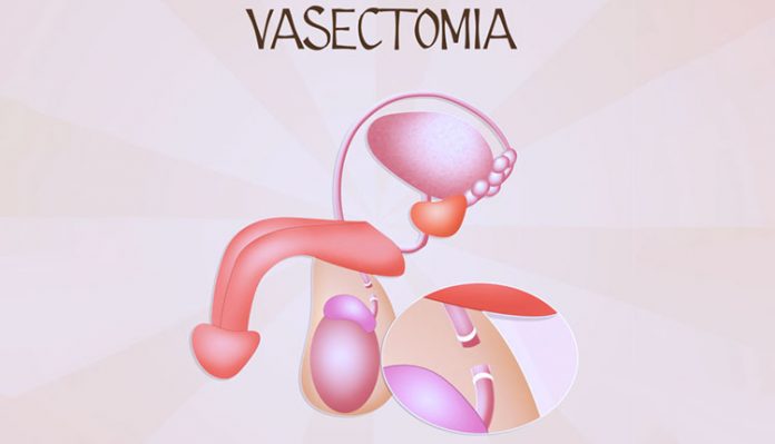 vasectomia-imagem