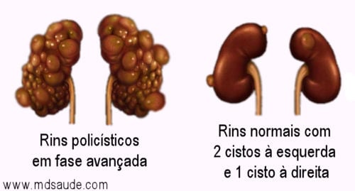 Rins policísticos
