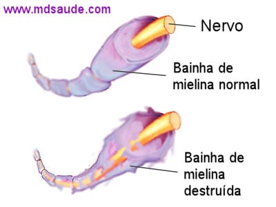 Destruição da bainha de mielina pela síndrome de Guillain-Barré.