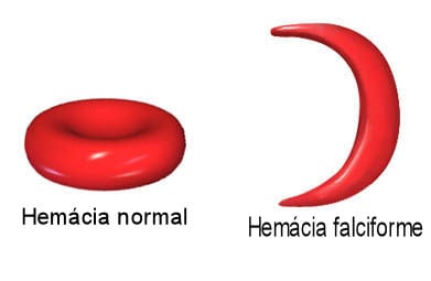 Hemácia na anemia falciforme