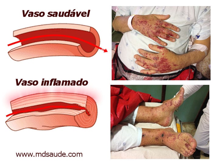 Vasculite de pés e mãos