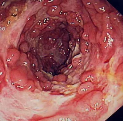 Doença de Crohn na colonoscopia