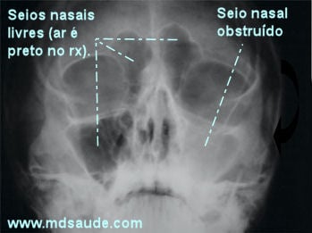 Sinusite ao raio-x