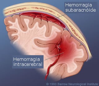 ACV hemorrágico: hemorragia intracerebral y hemorragia subaracnoidea. 
