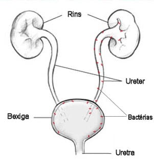 Cistite e pielonefrite