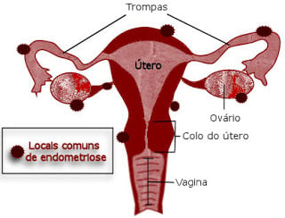 Locais comuns da endometriose