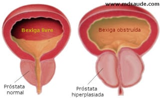 hiperplasia prostática benigna tratamiento scielo