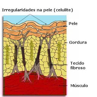 Como surge a celulite