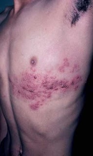 Herpes Zoster