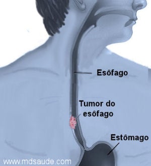 O sinal oculto do câncer de pulmão que pode ser visto nos dedos