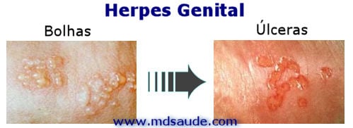 Bolhas e úlceras do herpes genital