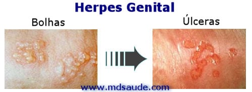 Herpes Genital Contagio Sintomas E Tratamento Md Saude