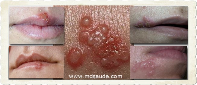 HERPES Tipos Causas Sintomas E Tratamento MDSade