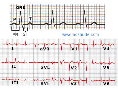 Qrs на экг что это. Комплекс QRS на ЭКГ. Двугорбый зубец р на ЭКГ. Электрокардиография зубцы QRS. Выпадение комплекса QRS на ЭКГ.