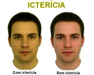 Icterícia