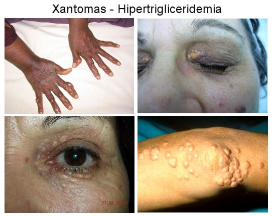 Xantomas na pele - hipertrigliceridemia
