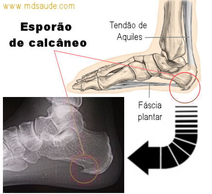Esporão de calcâneo