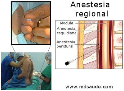 Anestesia regional - peridural e raquianestesia