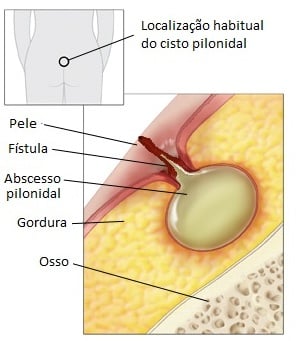 Cisto pilonidal: o que é, sintomas e cirurgia